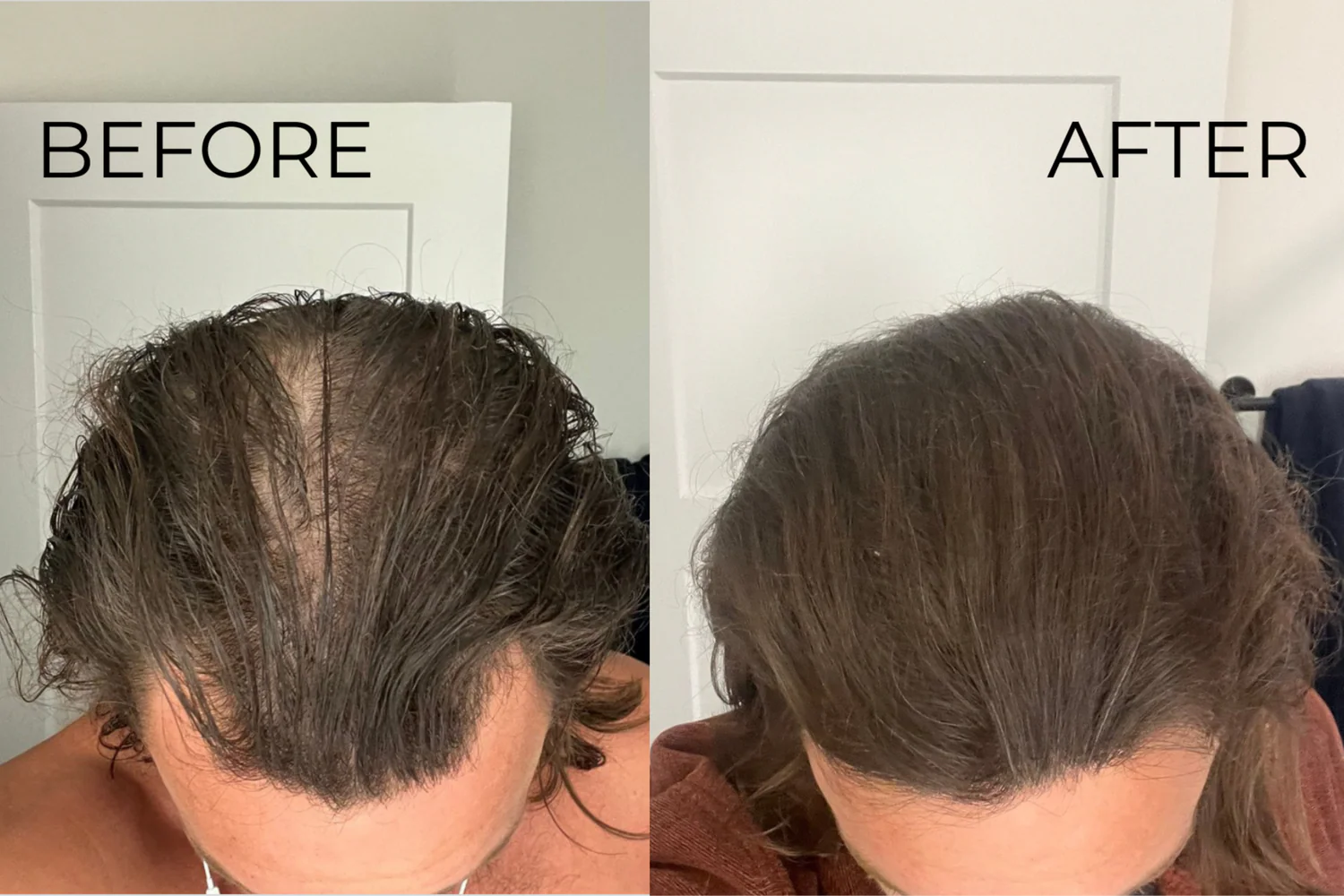 Before and after comparison of hair growth on a mans head.